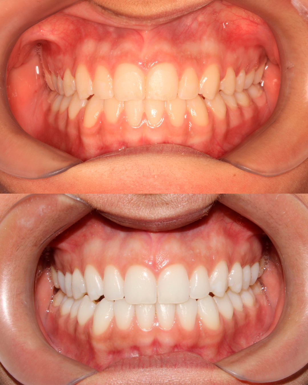 Reabilitação Oral Completa